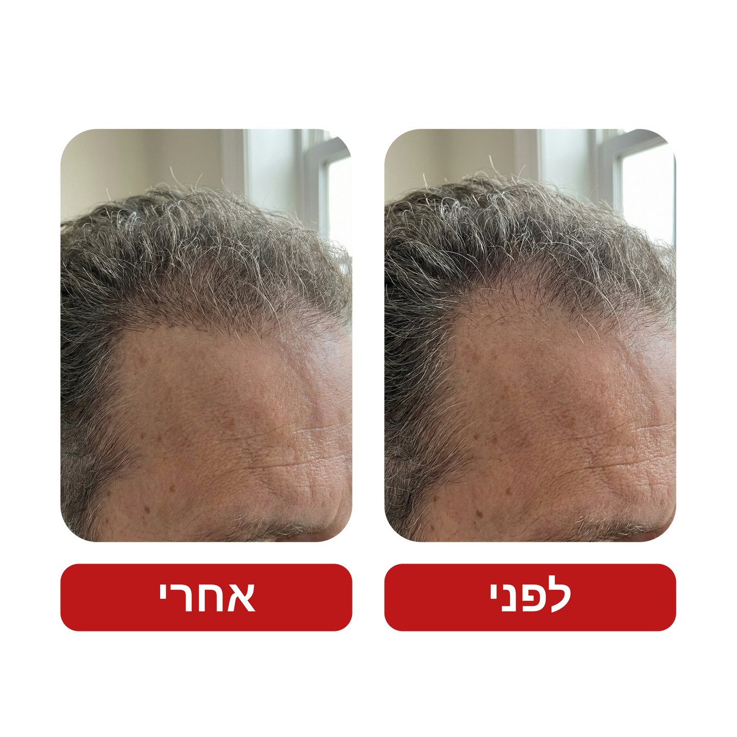 שמפו לצמיחת שיער