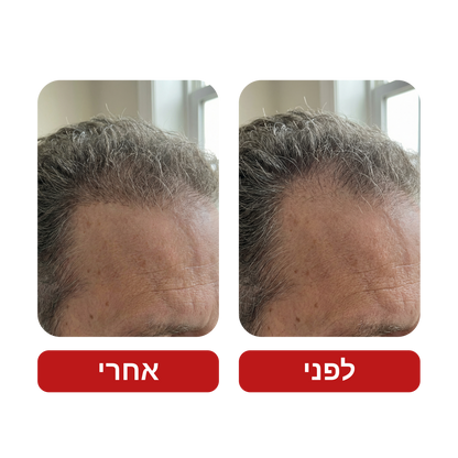 שמפו לצמיחת שיער