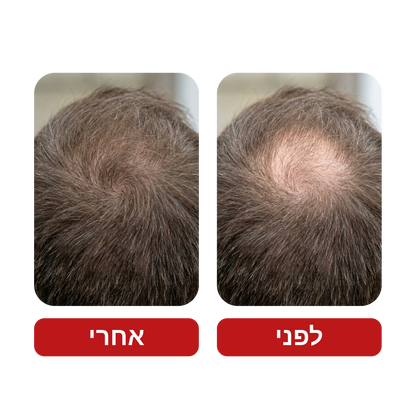 שמפו לצמיחת שיער